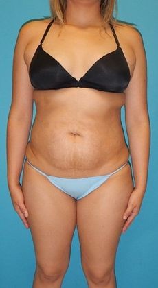 Before Image: Brazilian Butt Lift: Case 8 - front