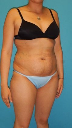 Before Image: Brazilian Butt Lift: Case 8 - right-front-oblique