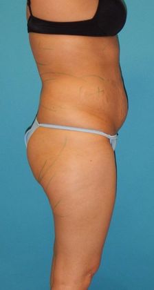 Before Image: Brazilian Butt Lift: Case 8 - right-side