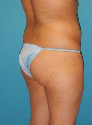 Before Image: Brazilian Butt Lift: Case 8 - right-back-oblique