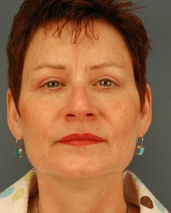 After Image: Eye Lift (Blepharoplasty): Case 8 - front