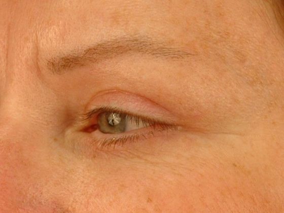 After Image: Eye Lift (Blepharoplasty): Case 8 - left-front-oblique