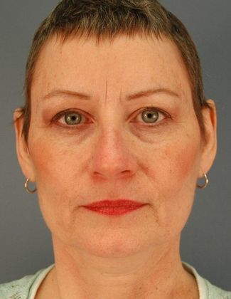Before Image: Eye Lift (Blepharoplasty): Case 8 - front