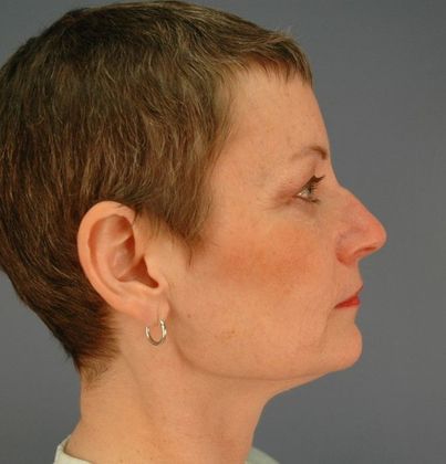 Before Image: Eye Lift (Blepharoplasty): Case 8 - right-side