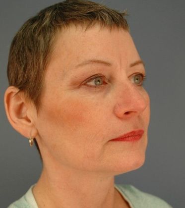 Before Image: Eye Lift (Blepharoplasty): Case 8 - right-front-oblique