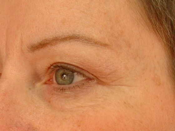 Before Image: Eye Lift (Blepharoplasty): Case 8 - left-front-oblique