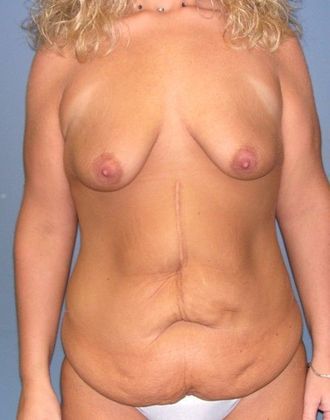 Before Image: Breast Lift Augmentation: Case 8 - front