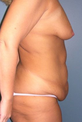 Before Image: Breast Lift Augmentation: Case 8 - right-side