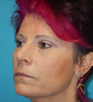 After Image: Soft Tissue Fillers: Case 8 - left-front-oblique