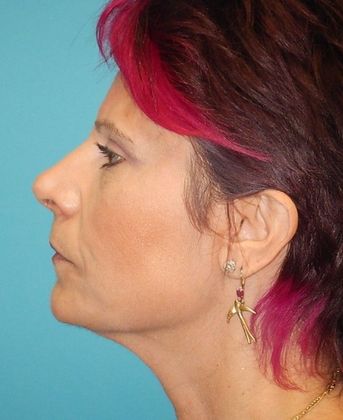 After Image: Soft Tissue Fillers: Case 8 - left-side