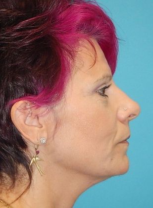 After Image: Soft Tissue Fillers: Case 8 - right-side