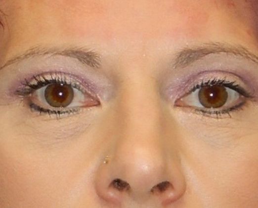 After Image: Soft Tissue Fillers: Case 8 - front