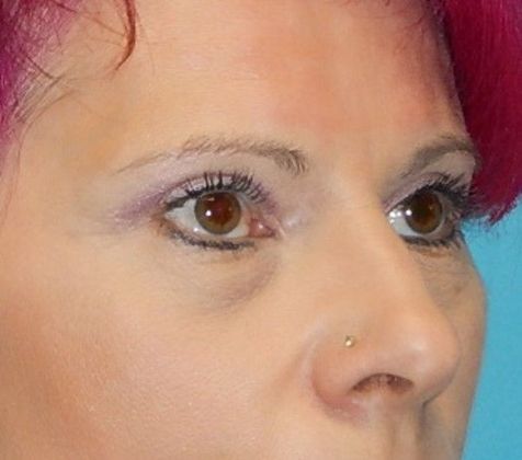 After Image: Soft Tissue Fillers: Case 8 - right-front-oblique