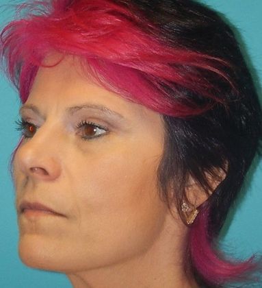 Before Image: Soft Tissue Fillers: Case 8 - left-front-oblique
