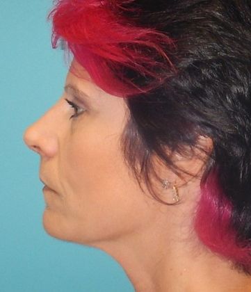 Before Image: Soft Tissue Fillers: Case 8 - left-side