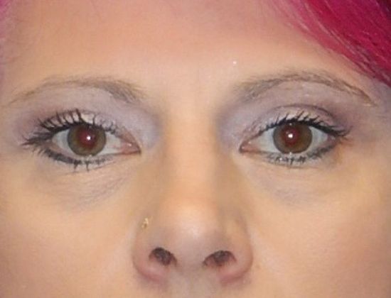 Before Image: Soft Tissue Fillers: Case 8 - front