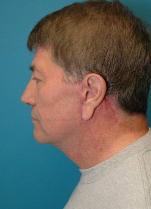 After Image: Neck Lift: Case 8 - left-side