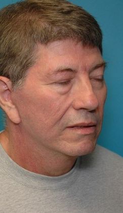 After Image: Neck Lift: Case 8 - right-front-oblique