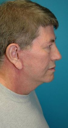 After Image: Neck Lift: Case 8 - right-side