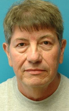 Before Image: Neck Lift: Case 8 - front