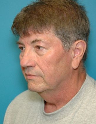 Before Image: Neck Lift: Case 8 - left-front-oblique