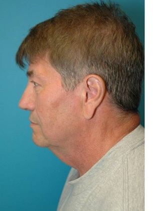 Before Image: Neck Lift: Case 8 - left-side