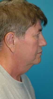 Before Image: Neck Lift: Case 8 - right-side