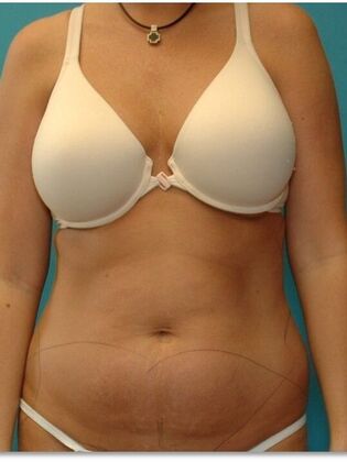 Before Image: Abdominoplasty: Case 9 - front