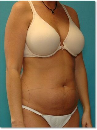 Before Image: Abdominoplasty: Case 9 - right-front-oblique