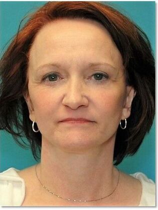 After Image: Face & Neck Lifts: Case 9 - front