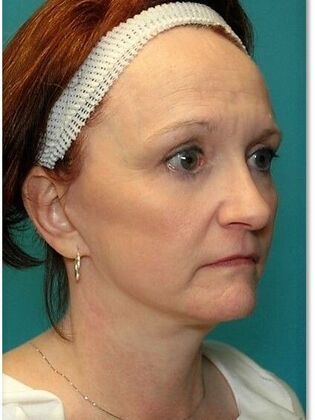 After Image: Face & Neck Lifts: Case 9 - right-front-oblique