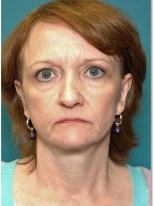 Before Image: Face & Neck Lifts: Case 9 - front