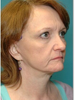 Before Image: Face & Neck Lifts: Case 9 - right-front-oblique