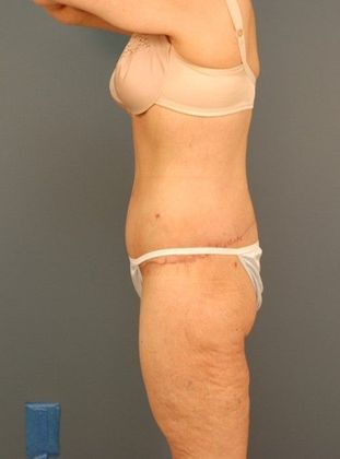 After Image: Body Lifts: Case 9 - left-side