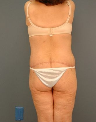 After Image: Body Lifts: Case 9 - back