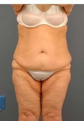 Before Image: Body Lifts: Case 9 - front