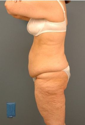Before Image: Body Lifts: Case 9 - left-side