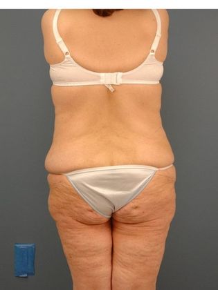 Before Image: Body Lifts: Case 9 - back