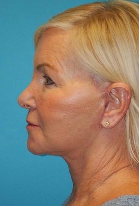 After Image: Mini Facelift: Case 9 - left-side