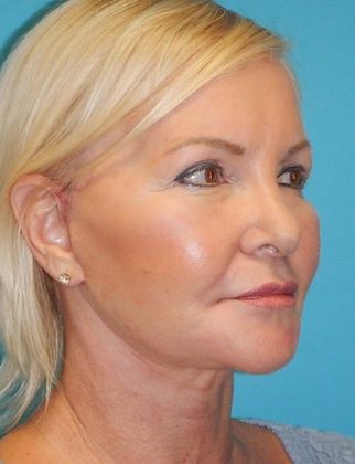 After Image: Mini Facelift: Case 9 - right-front-oblique