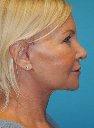 After Image: Mini Facelift: Case 9 - right-side