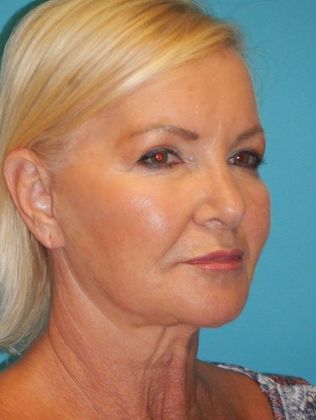 Before Image: Mini Facelift: Case 9 - right-front-oblique