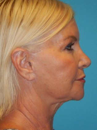 Before Image: Mini Facelift: Case 9 - right-side