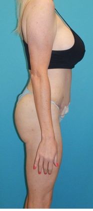 After Image: Brazilian Butt Lift: Case 9 - right-side