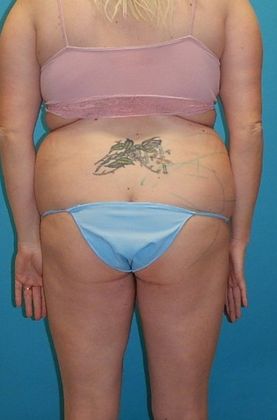 Before Image: Brazilian Butt Lift: Case 9 - back