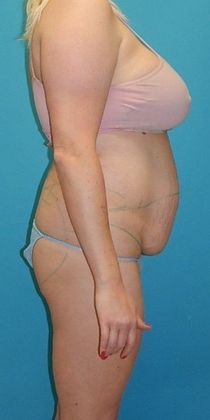 Before Image: Brazilian Butt Lift: Case 9 - right-side