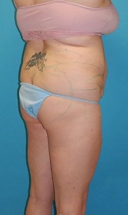 Before Image: Brazilian Butt Lift: Case 9 - right-back-oblique