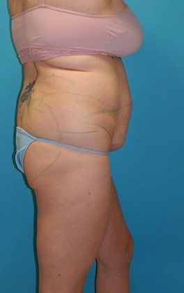 Before Image: Brazilian Butt Lift: Case 9 - right-side