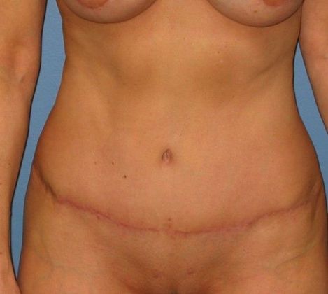 After Image: Mommy Makeover: Case 9 - front
