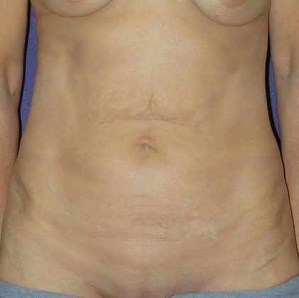 Before Image: Mommy Makeover: Case 9 - front
